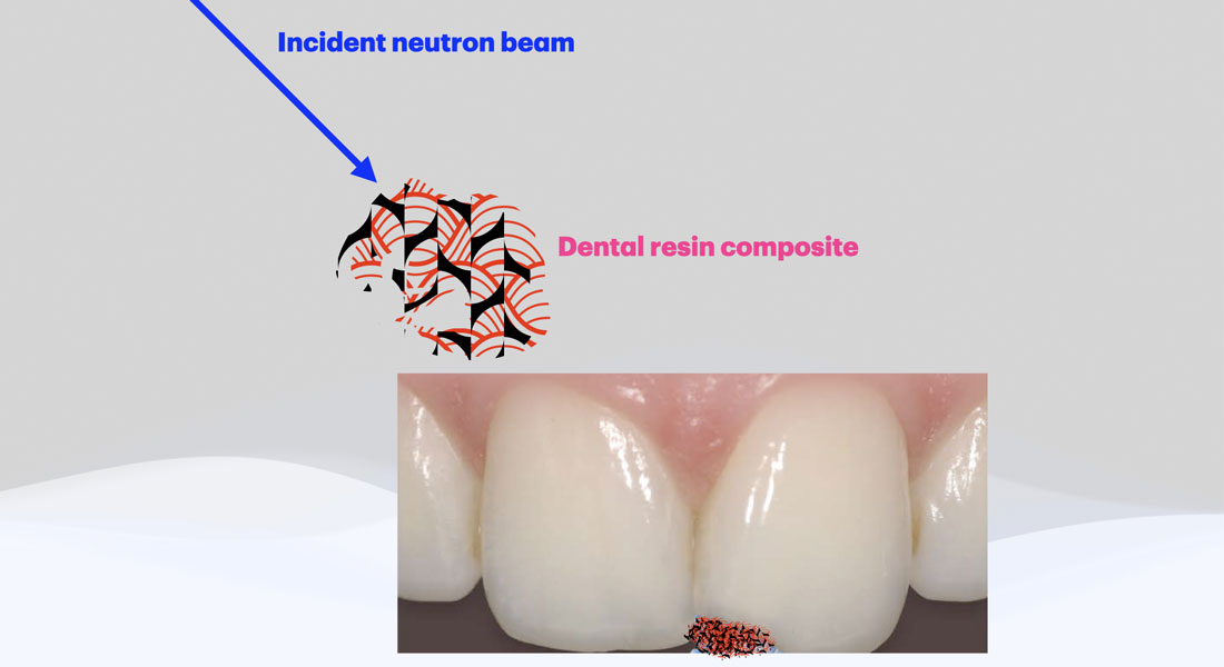 When the dental filling material is subjected to the dentist’s blue light it hardens. Neutron scattering can analyze the process in real time and lead to the development of better materials for dental fillings. Photo/illustration: Heloisa Bordallo