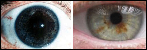 Øjne med stor or lille iris
